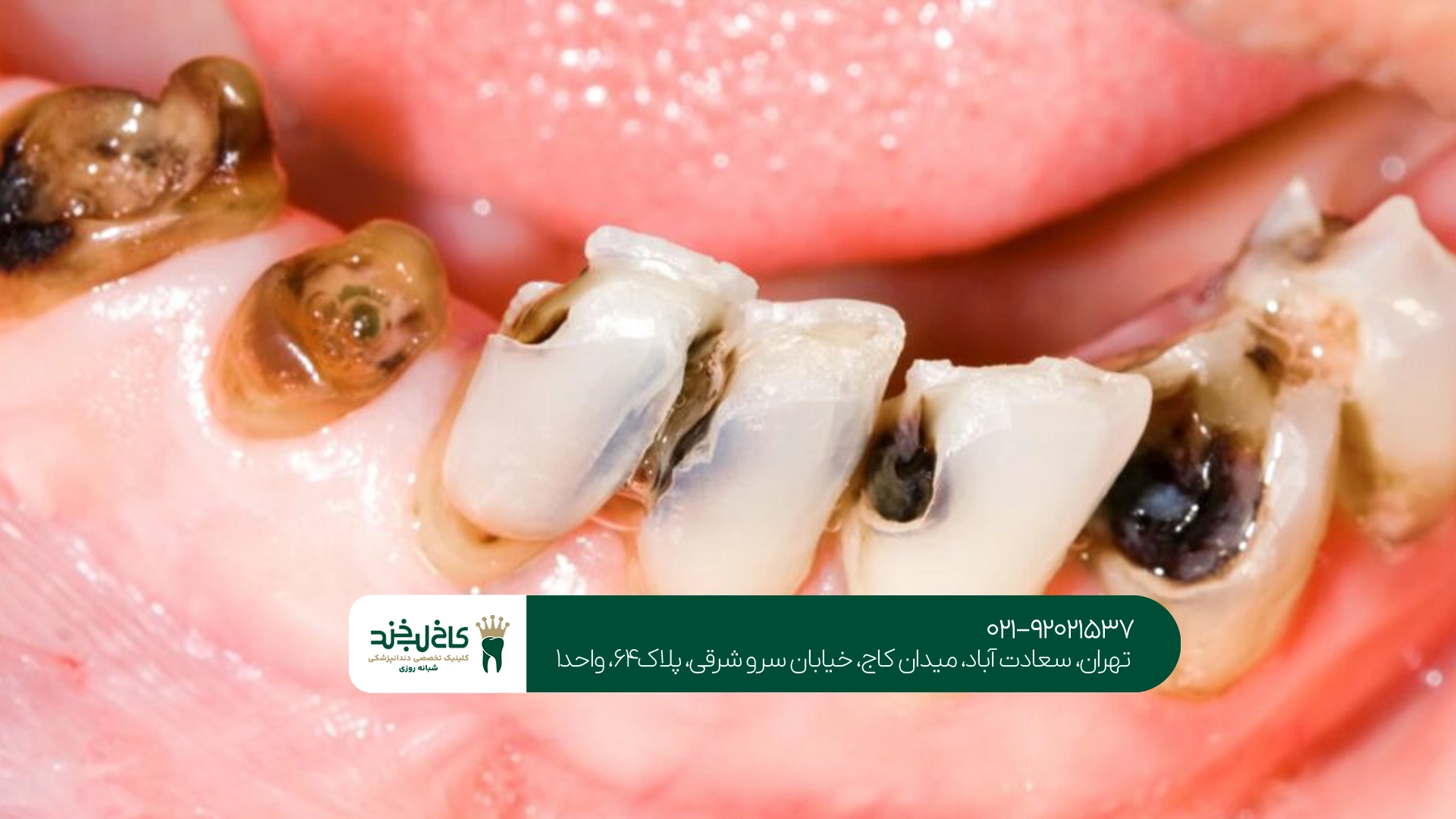 مهمترین عوامل پوسیدگی سریع دندان