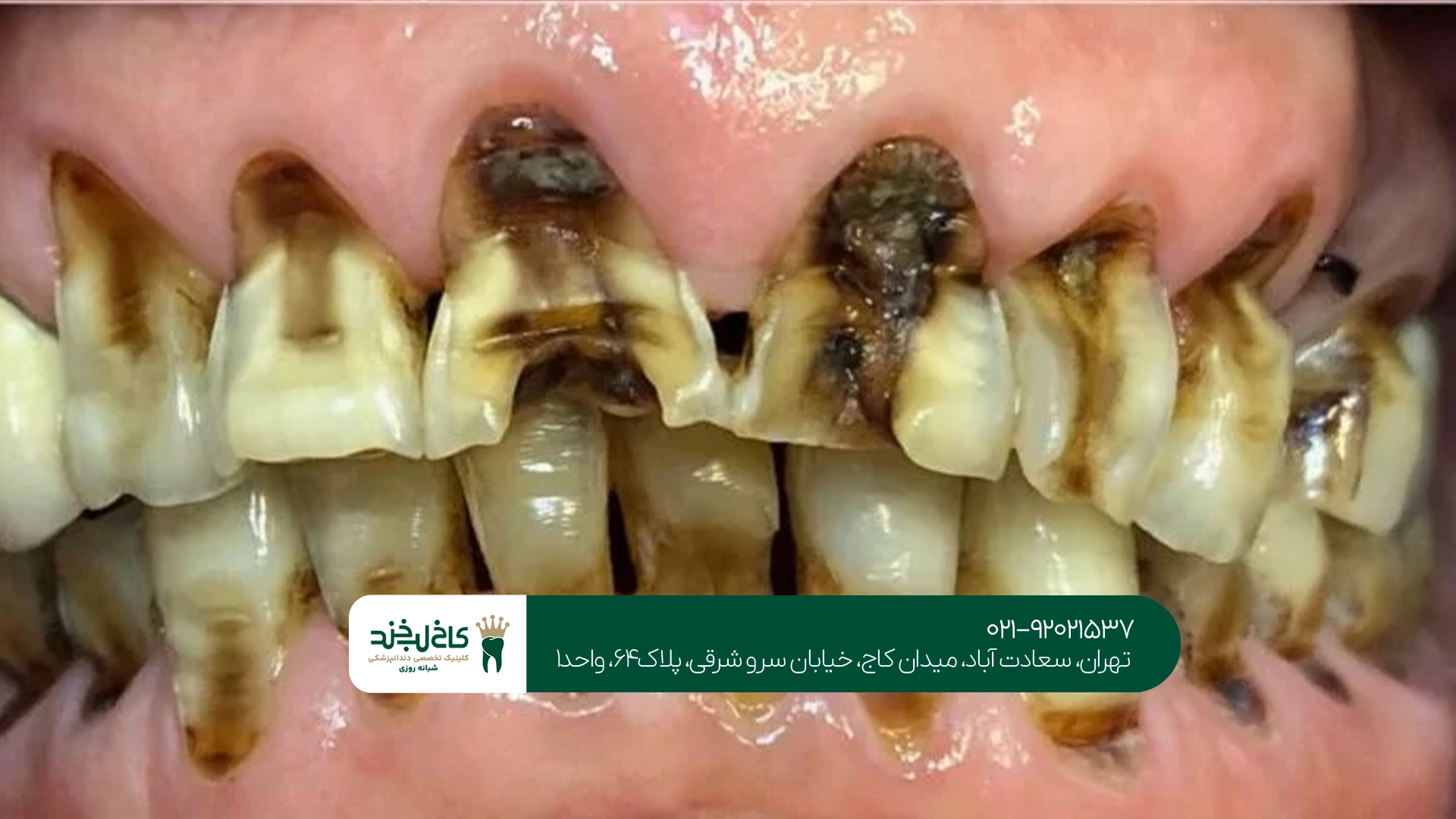 بهترین روش درمان پوسیدگی سریع دندان
