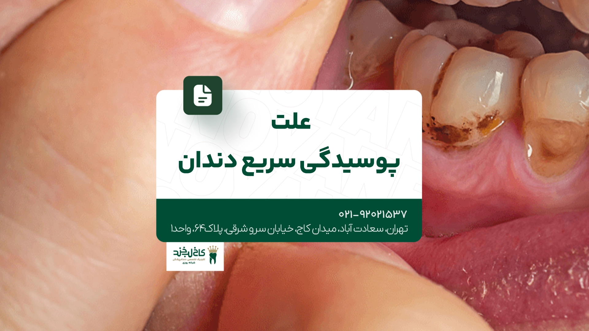 علت پوسیدگی سریع دندان