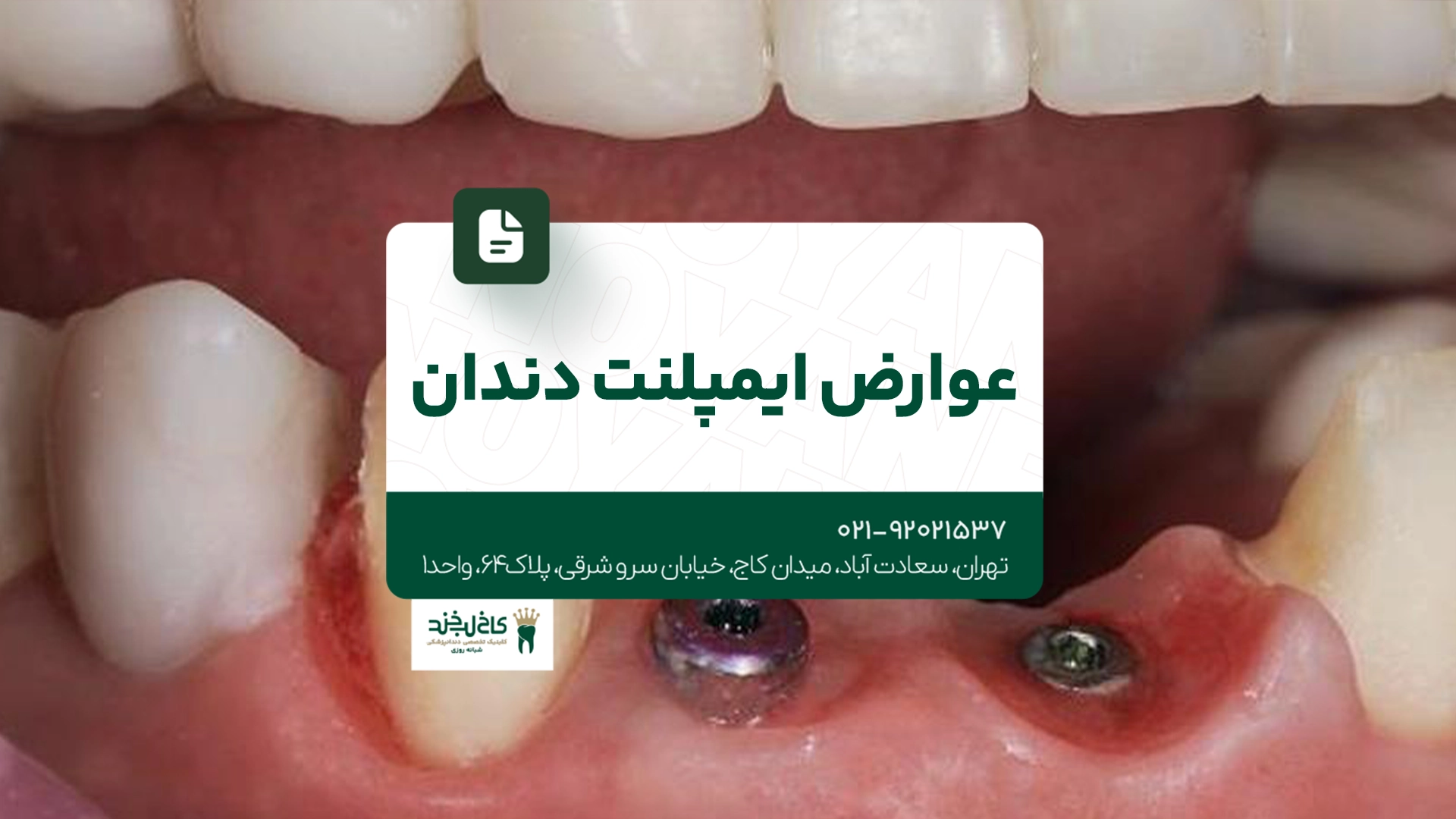 عوارض ایمپلنت دندان