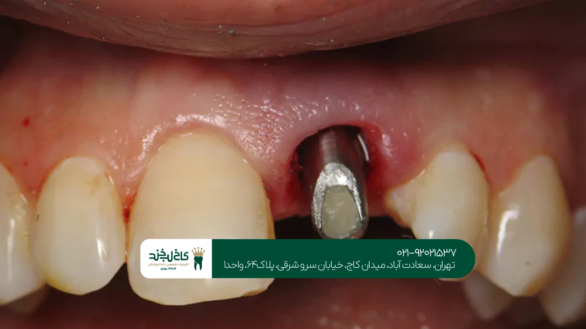 چه افرادی بیشتر در معرض عوارض ایمپلنت دندان هستند؟