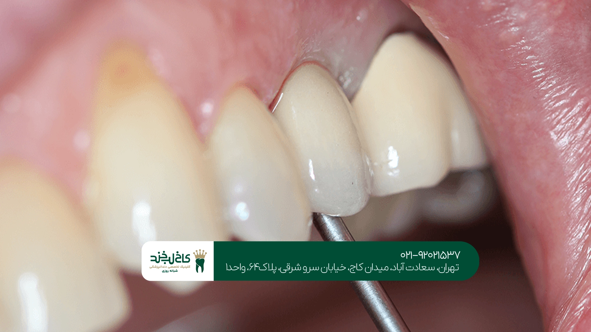 بهترین مرکز ایمپلنت دندان