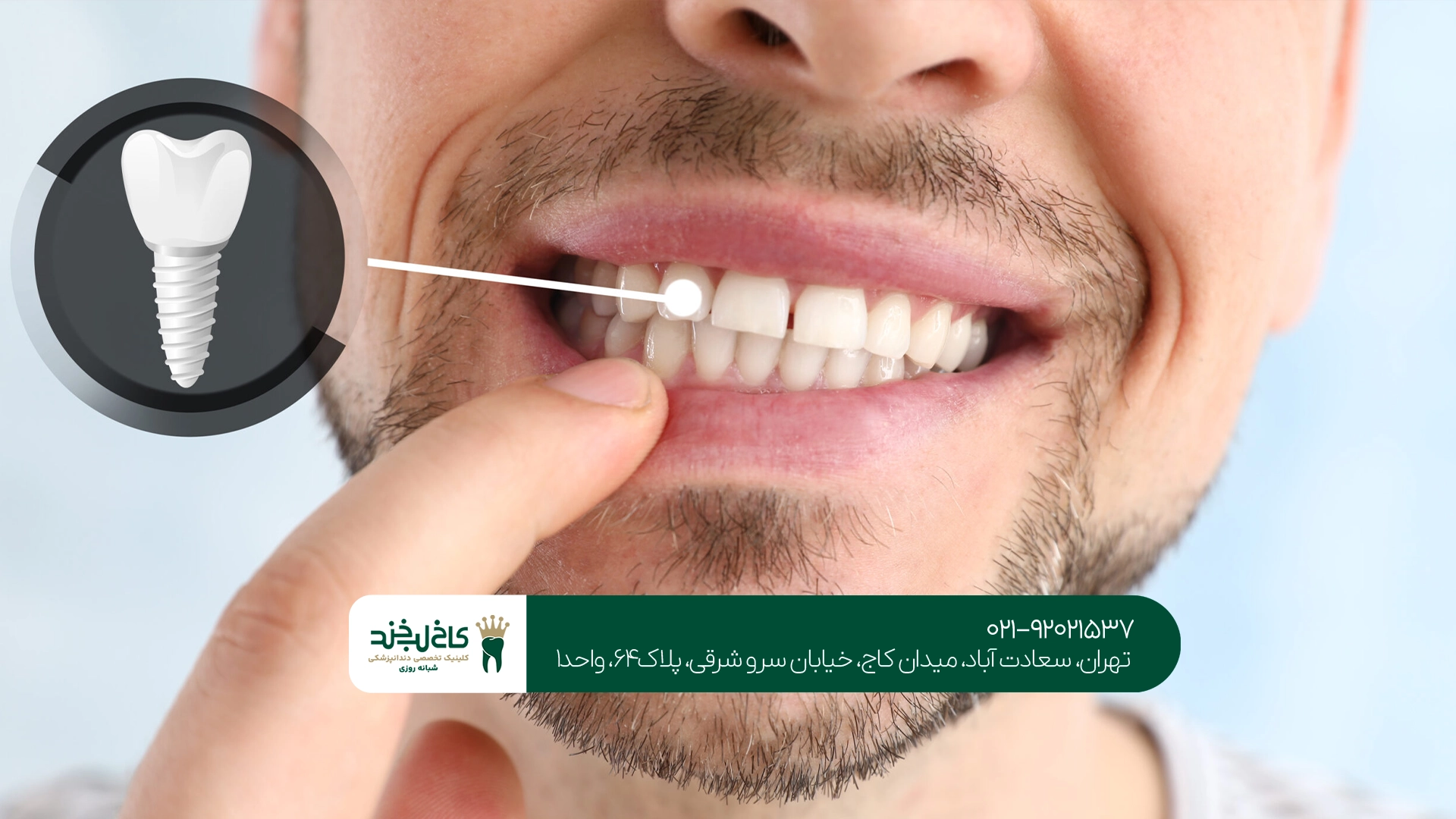شایعترین عوارض ایمپلنت دندان بعد از جراحی