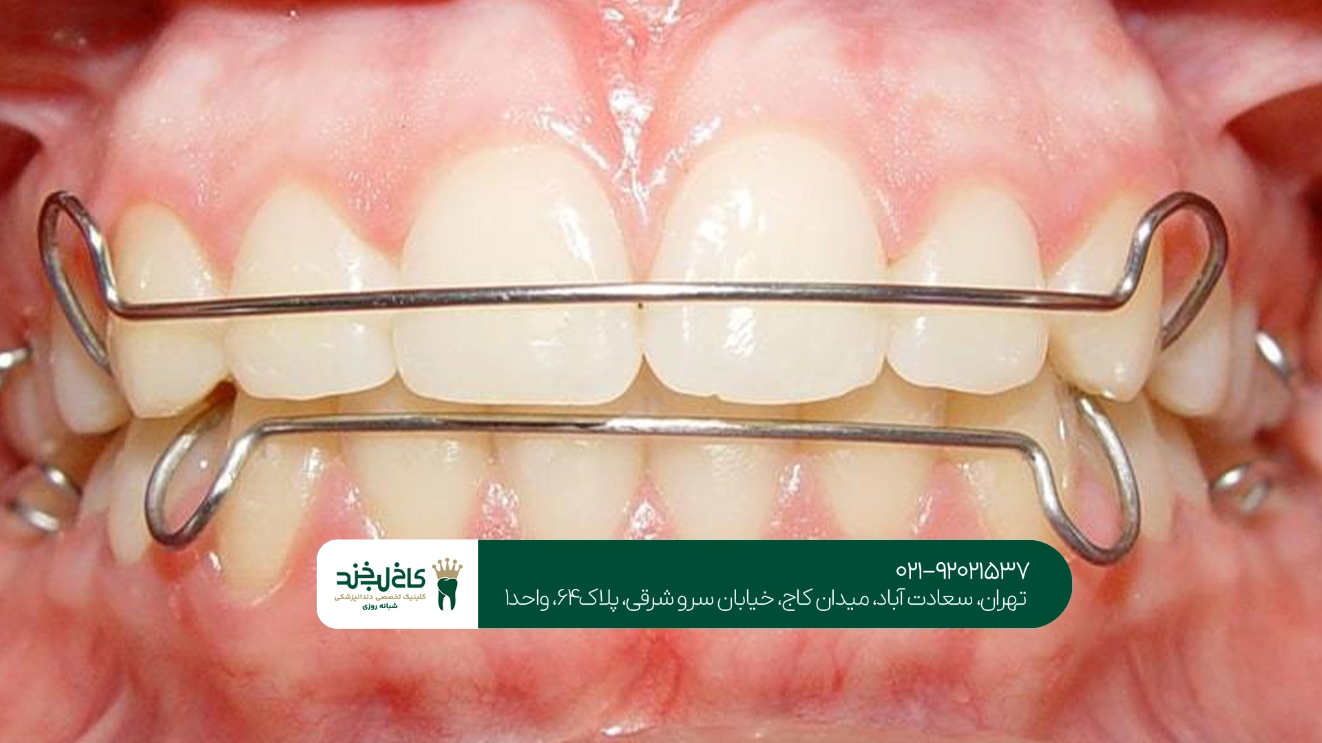 اهمیت استفاده از فضا نگهدار دندان کودکان