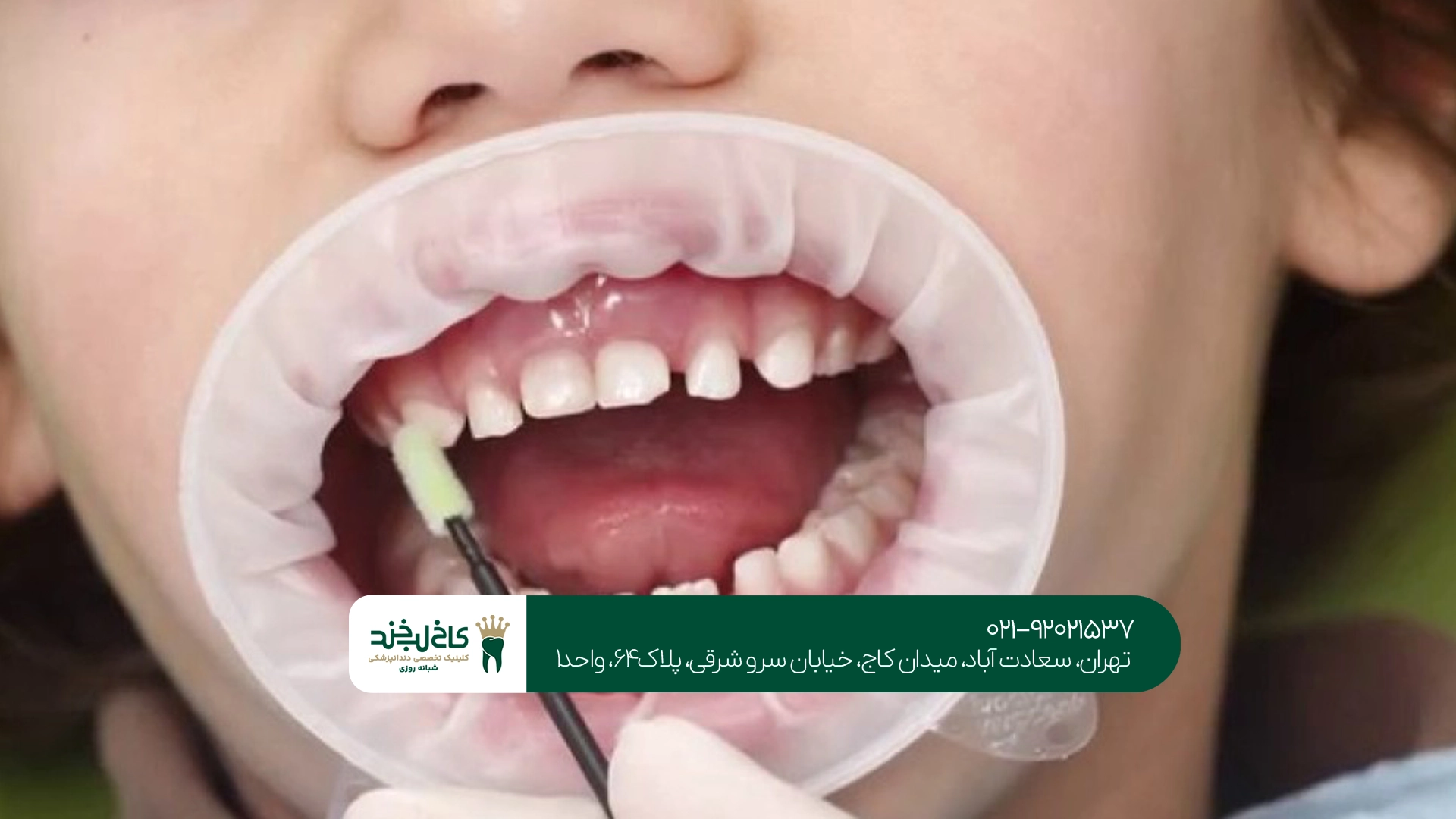 فواید فلورایدتراپی برای سلامت دندان کودکان فواید فلورایدتراپی برای سلامت دندان کودکان