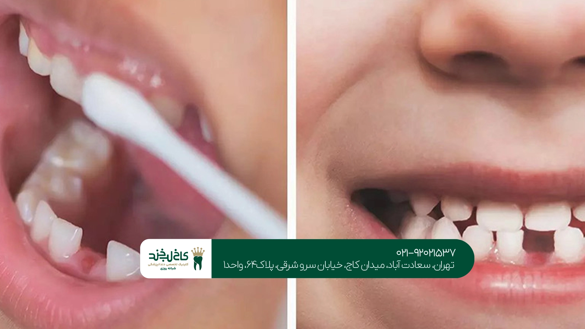 فلورایدتراپی کودکان در تهران فلورایدتراپی کودکان در تهران