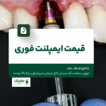 قیمت ایمپلنت فوری