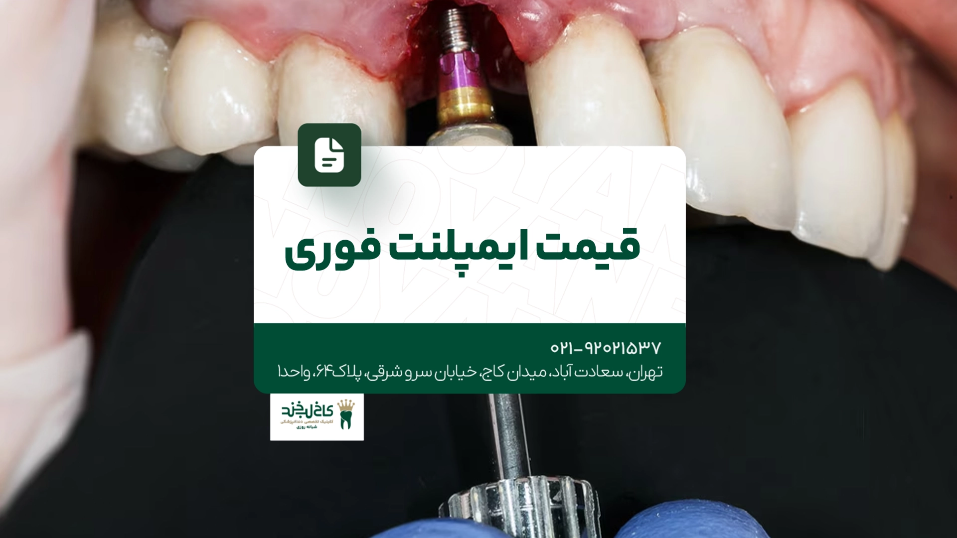 قیمت ایمپلنت فوری