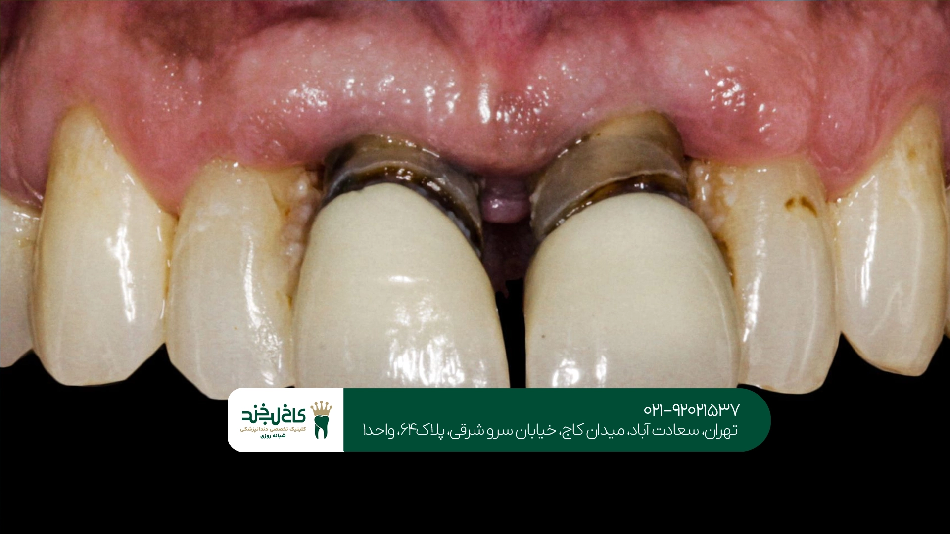 چگونه قیمت ایمپلنت فوری محاسبه میشود؟