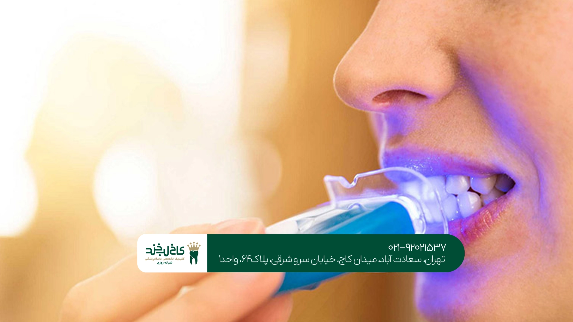 آیا بلیچینگ دندان ارزش هزینه را دارد؟