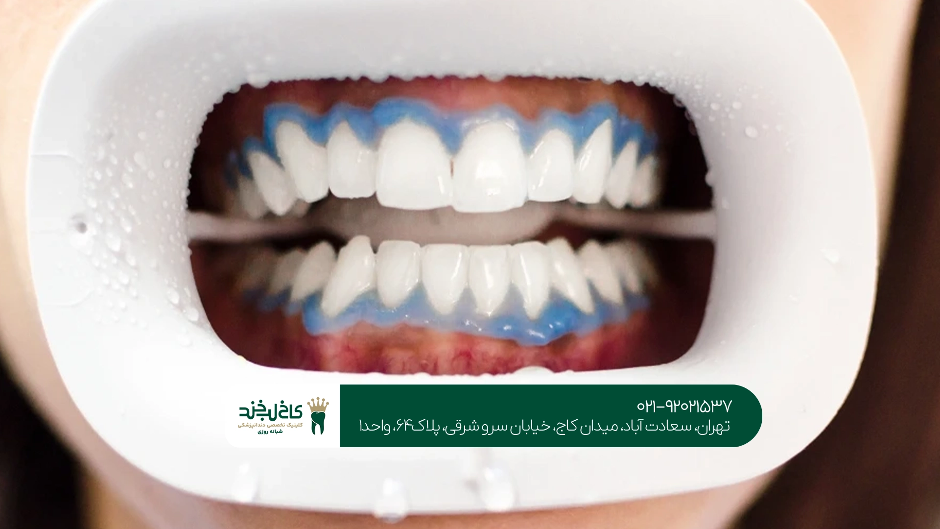 قیمت بلیچینگ دندان تهران