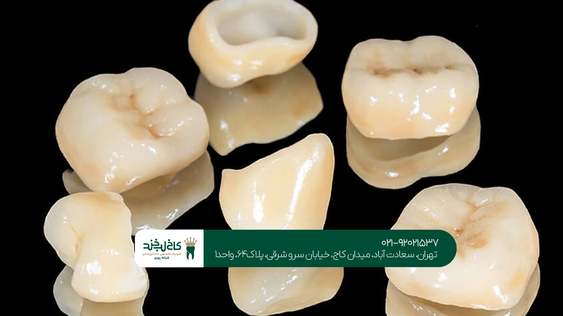روکش دندان تهران