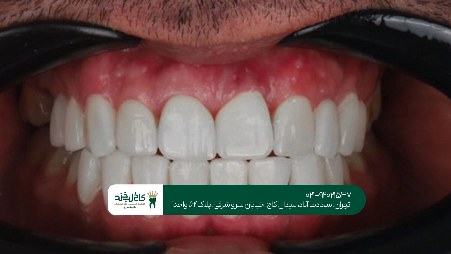 قیمت روکش دندان در تهران قیمت روکش دندان در تهران