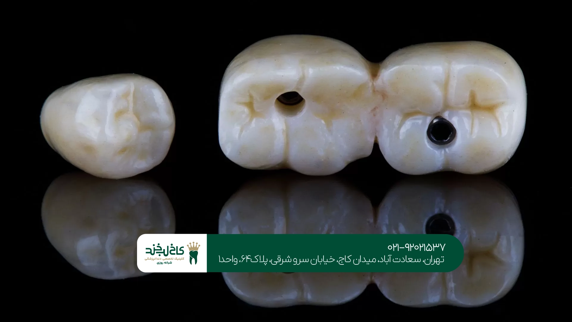 هزینه روکش دندان برای دندان جلو و عقب چقدر متفاوت است؟