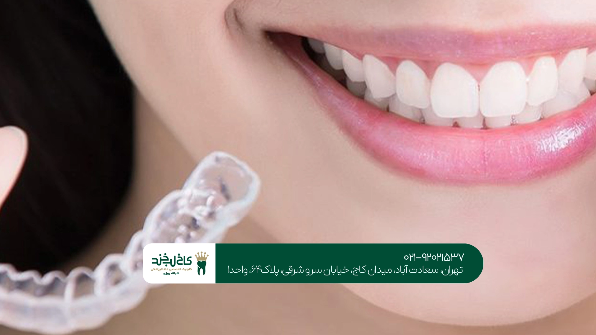 قیمت روکش دندان در تهران قیمت روکش دندان در تهران