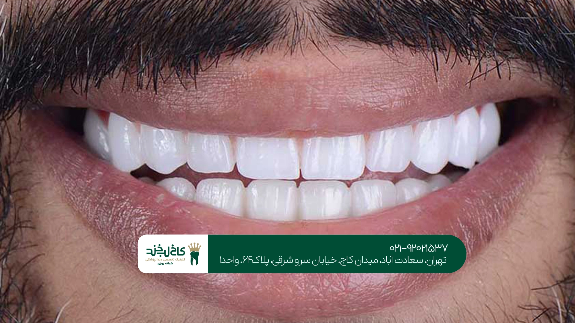 تفاوت لبخند هالیوودی با کامپوزیت و لمینت