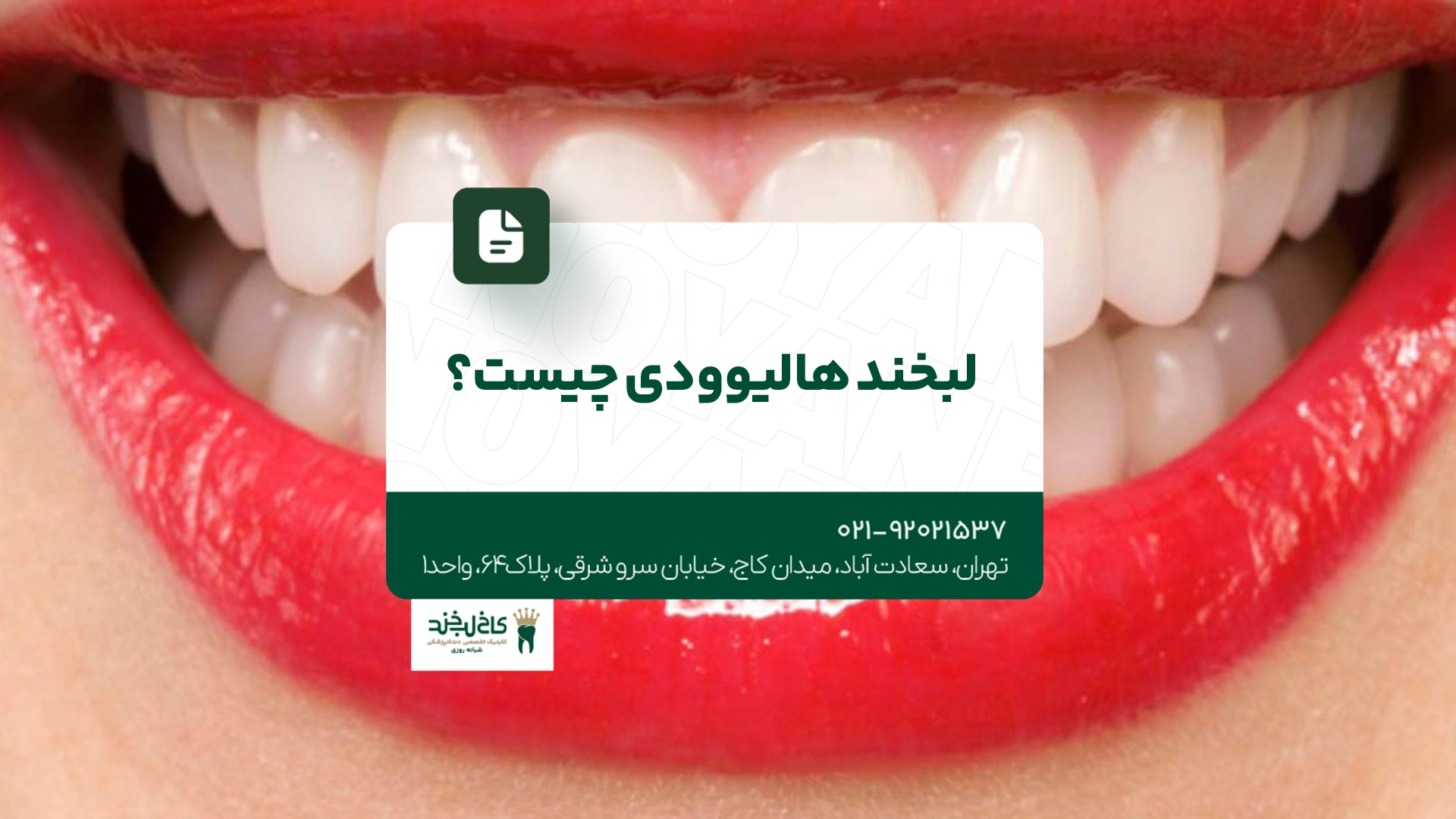 لبخند هالیوودی چیست