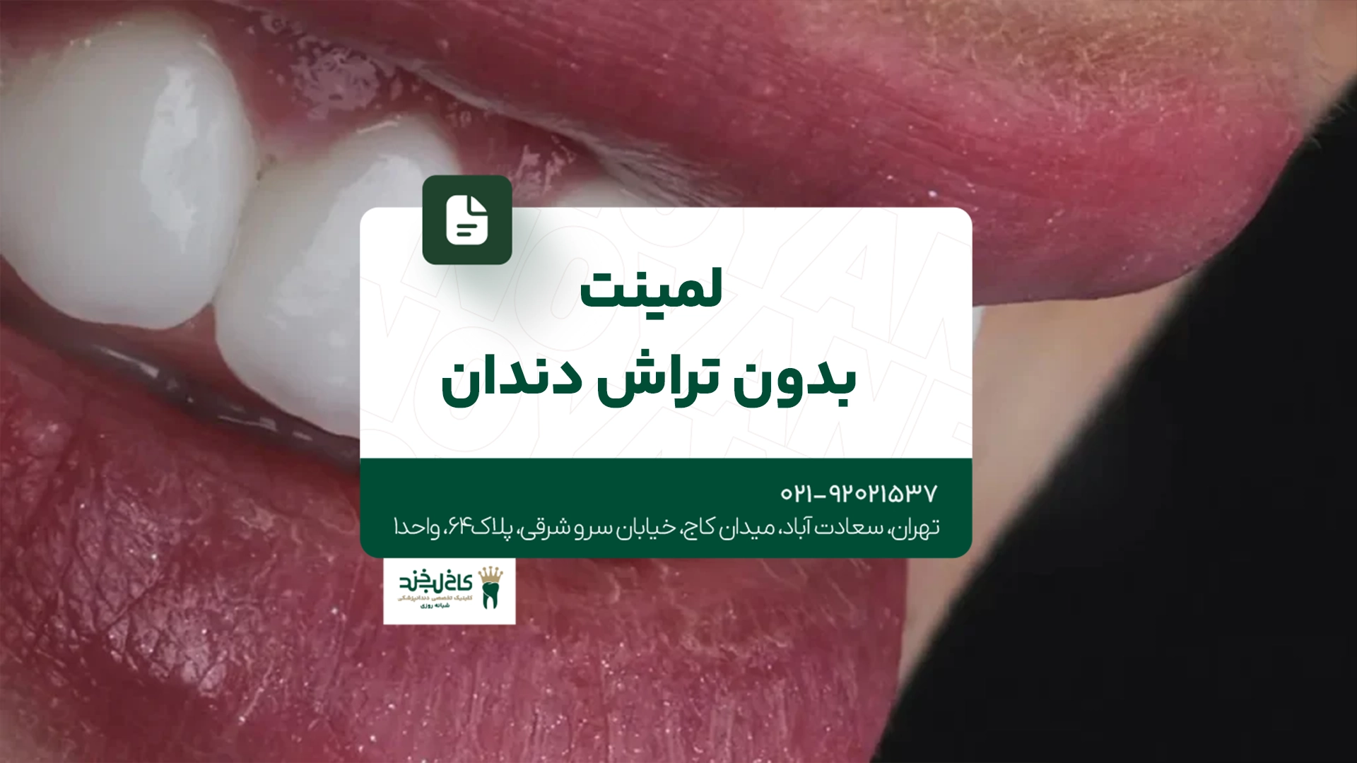 لمینت بدون تراش دندان