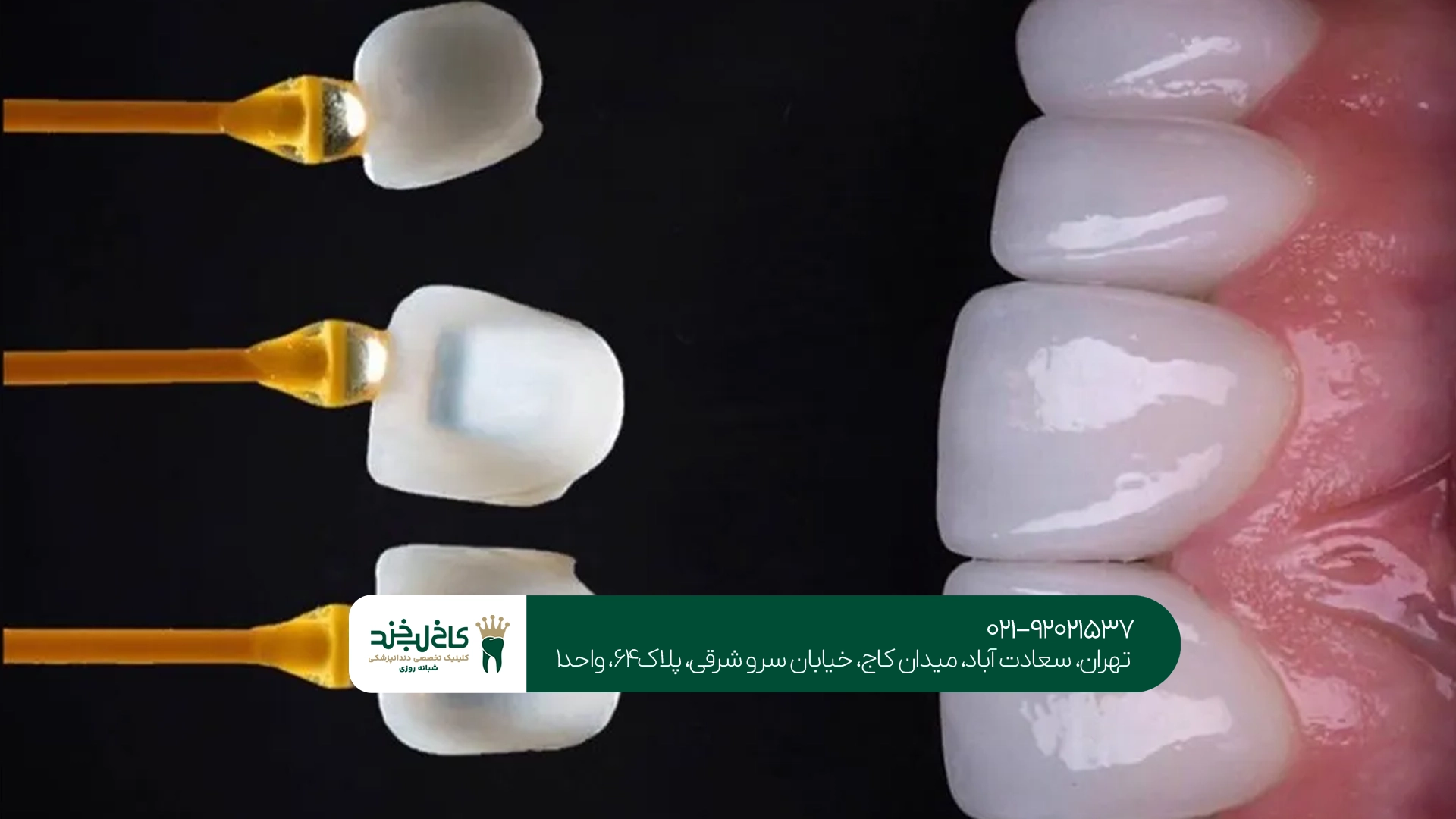 مراقبتهای لازم بعد از انجام لمینت بدون تراش