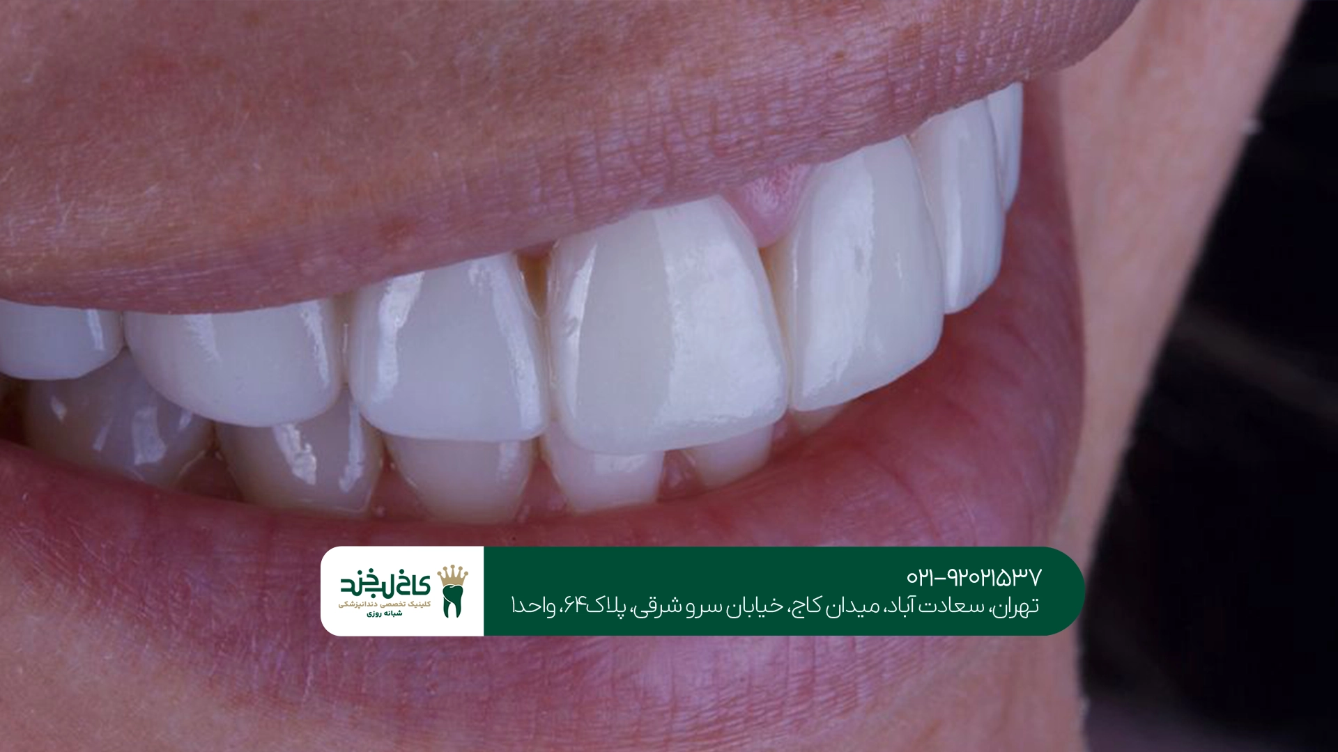 لمینت بدون تراش دندان در تهران