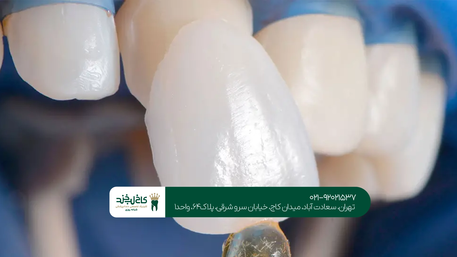 لمینت بدون تراش با بهترین کیفیت و متریال