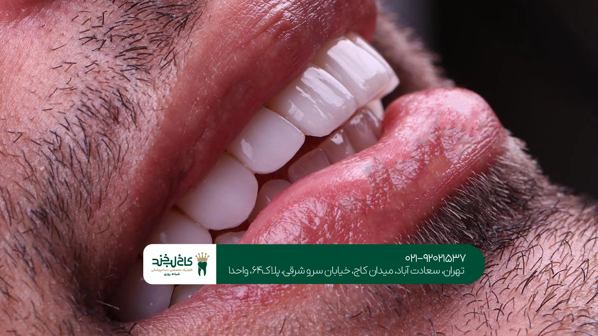 مراحل انجام لمینت دندان در کلینیک کاخ لبخند مراحل انجام لمینت دندان در کلینیک کاخ لبخند