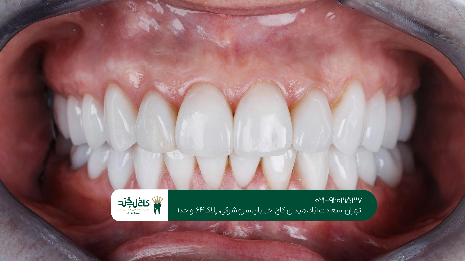 هزینه لمینت دندان اقساطی