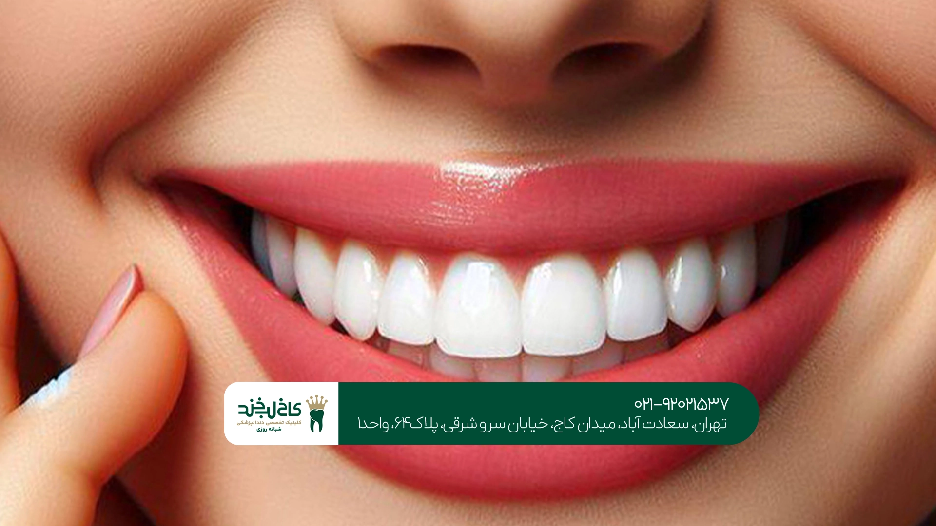 لمینت دندان اقساطی در تهران