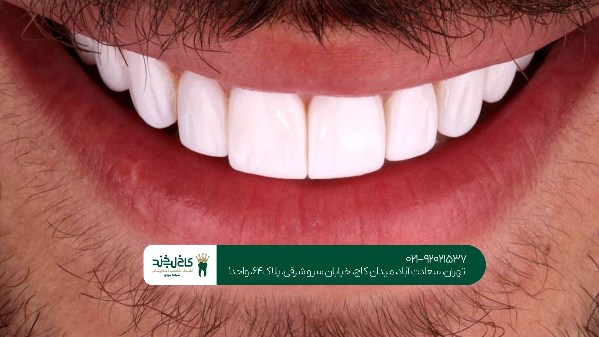 بهترین کلینیک لمینت دندان اقساطی