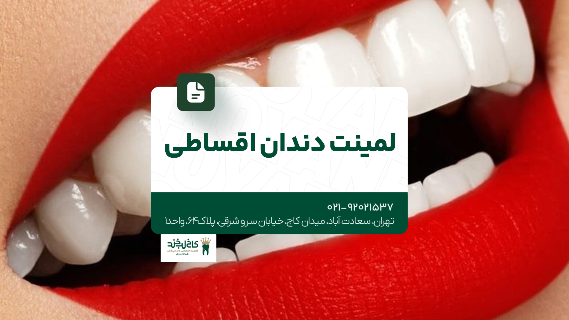لمینت دندان اقساطی
