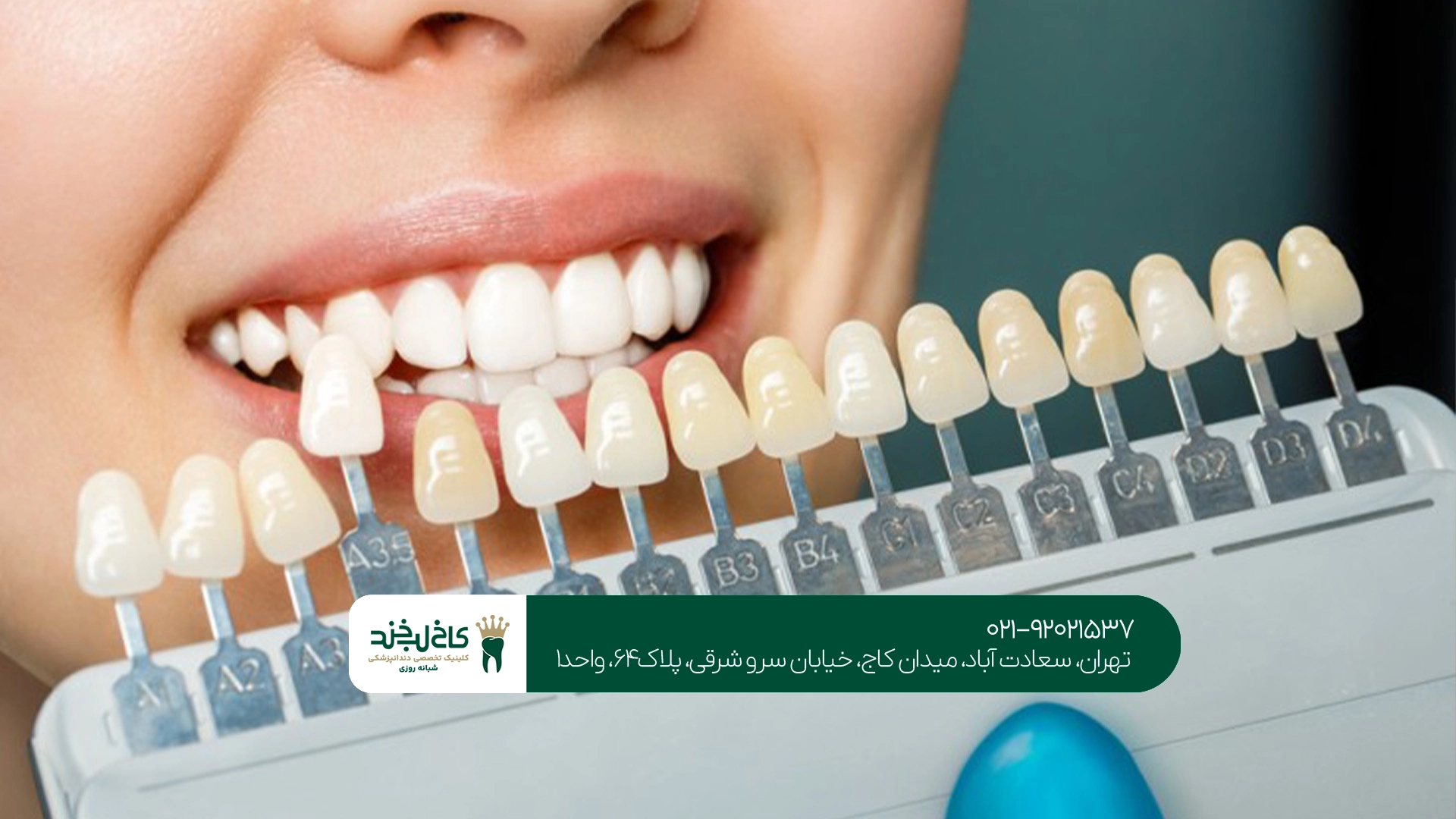 مرکز تخصصی لمینت دندان تهران