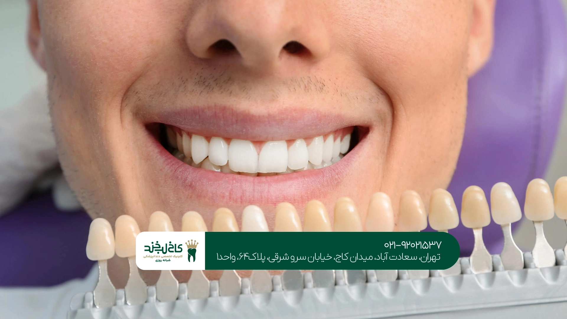 لمینت دندان طبیعی چقدر ماندگاری دارد؟