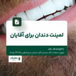 لمینت دندان برای آقایان