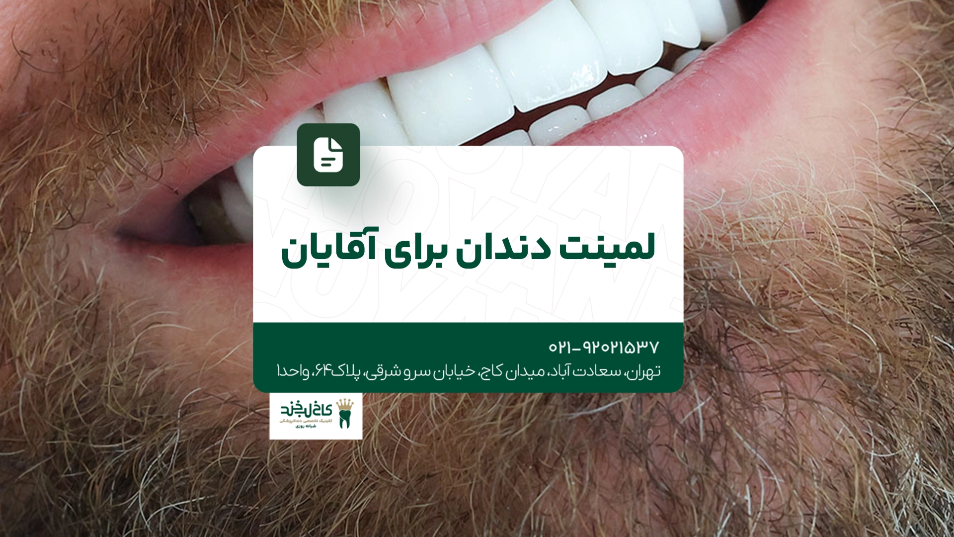 لمینت دندان برای آقایان