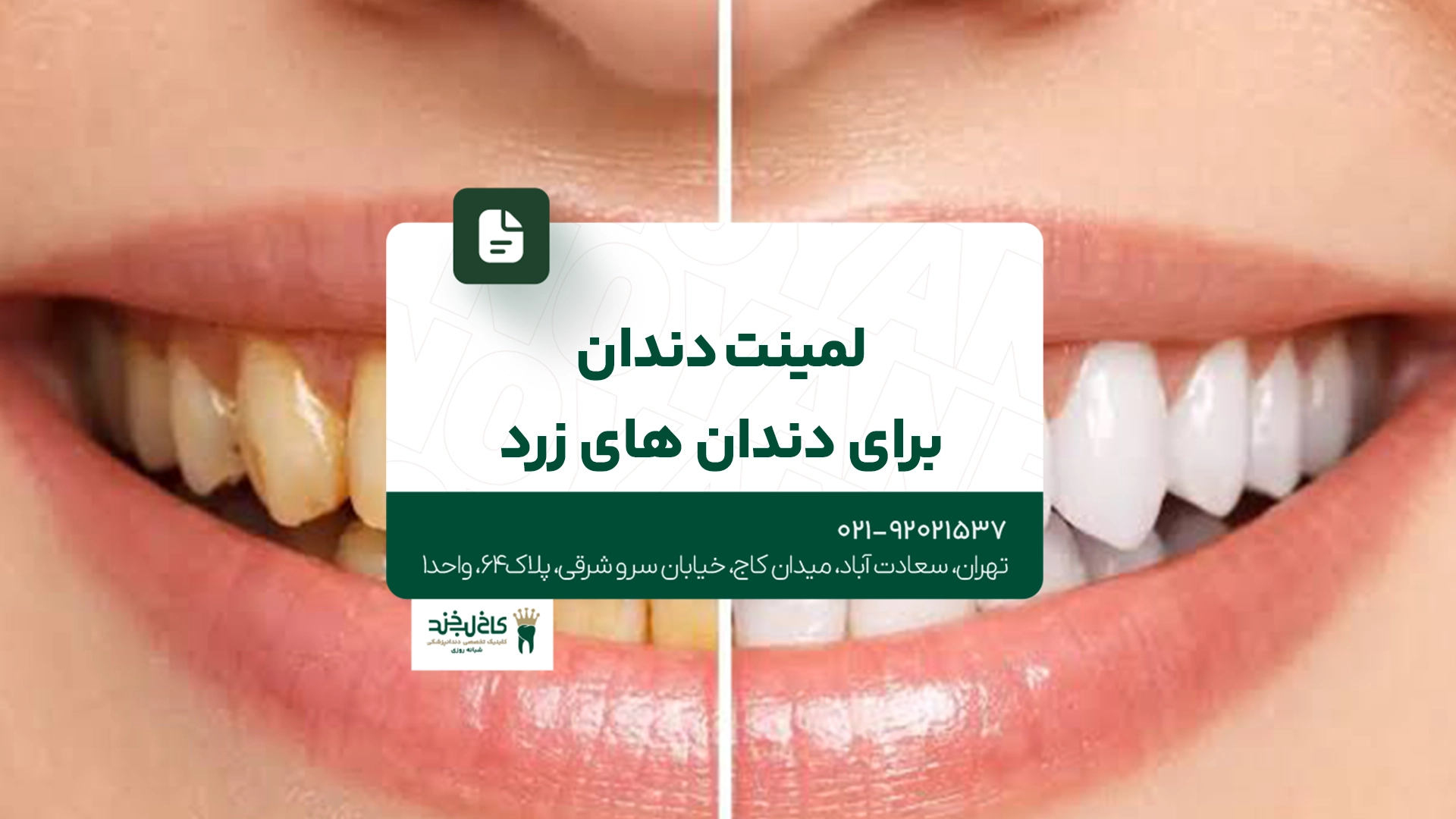 لمینت دندان برای دندانهای زرد لمینت دندان برای دندانهای زرد