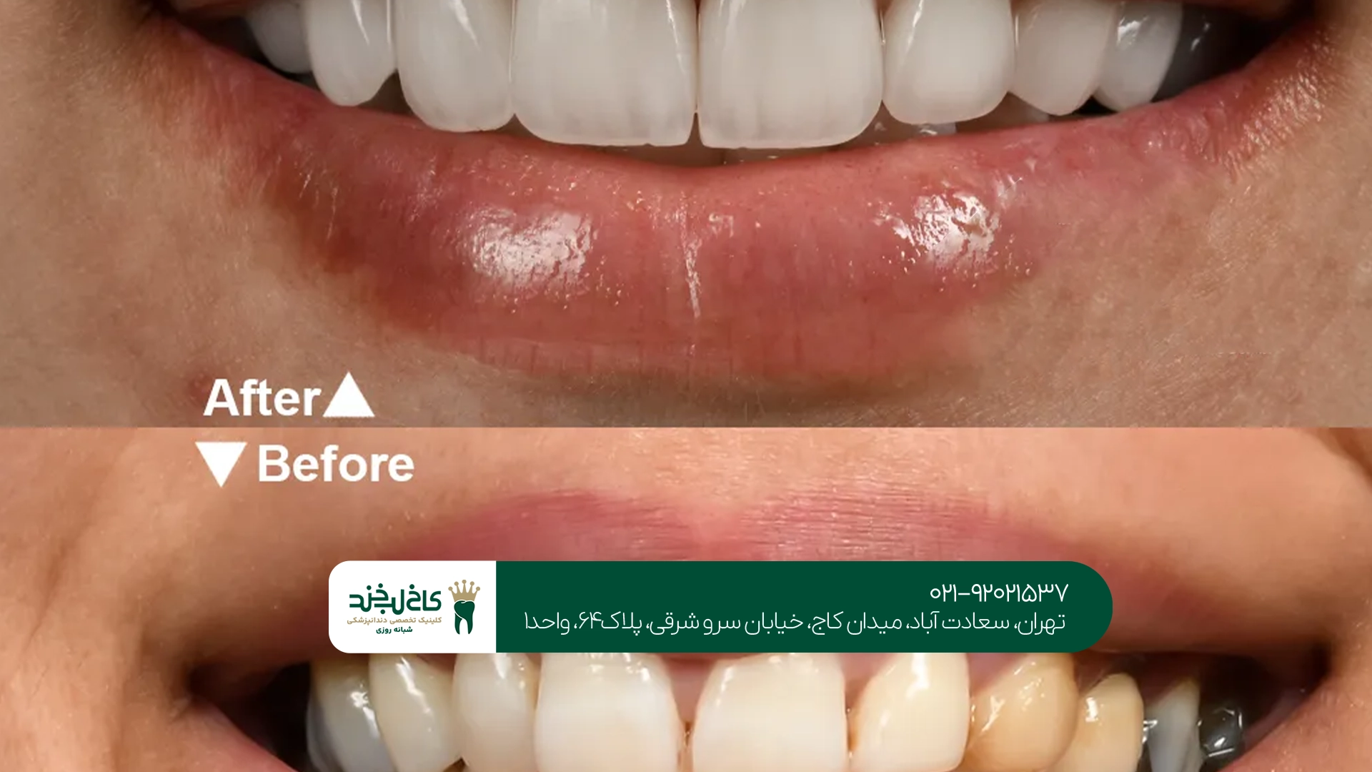 لمینت دندان در تهران لمینت دندان در تهران