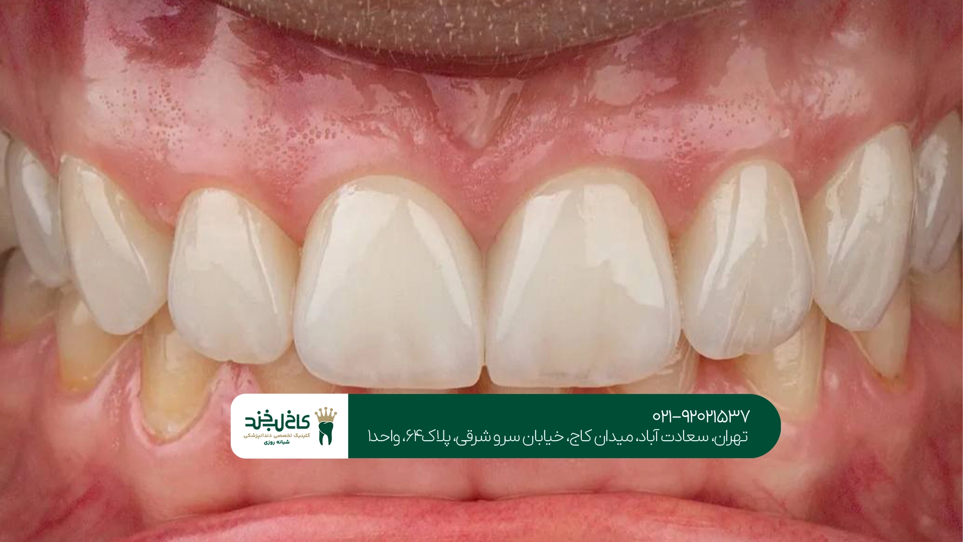 مزایا و معایب لمینت برای دندانهای زرد مزایا و معایب لمینت برای دندانهای زرد