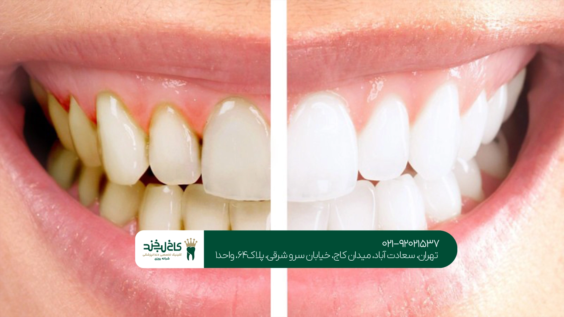 بهترین مرکز لمینت دندان بهترین مرکز لمینت دندان