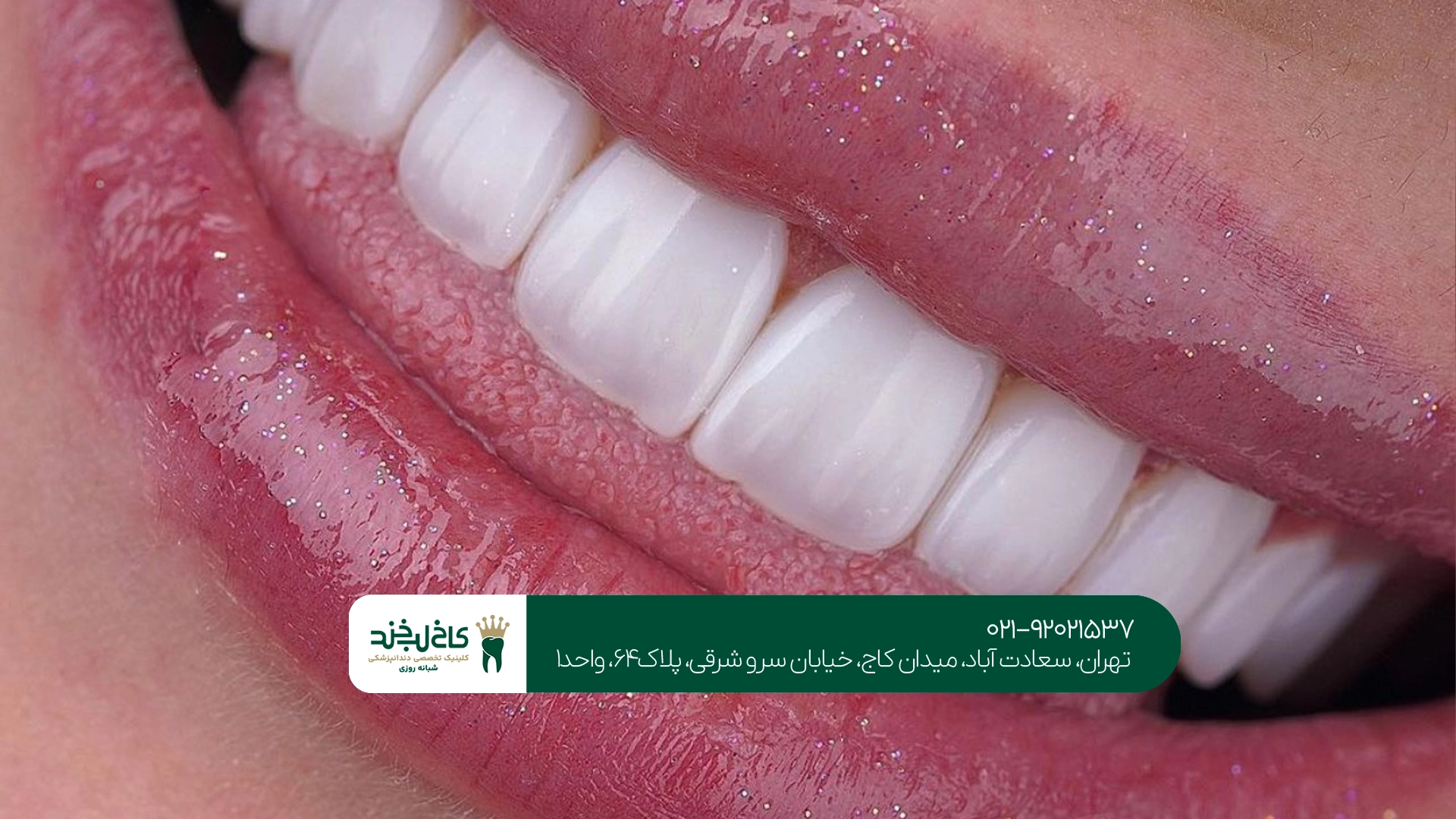 بهترین کلینیک لمینت دندان