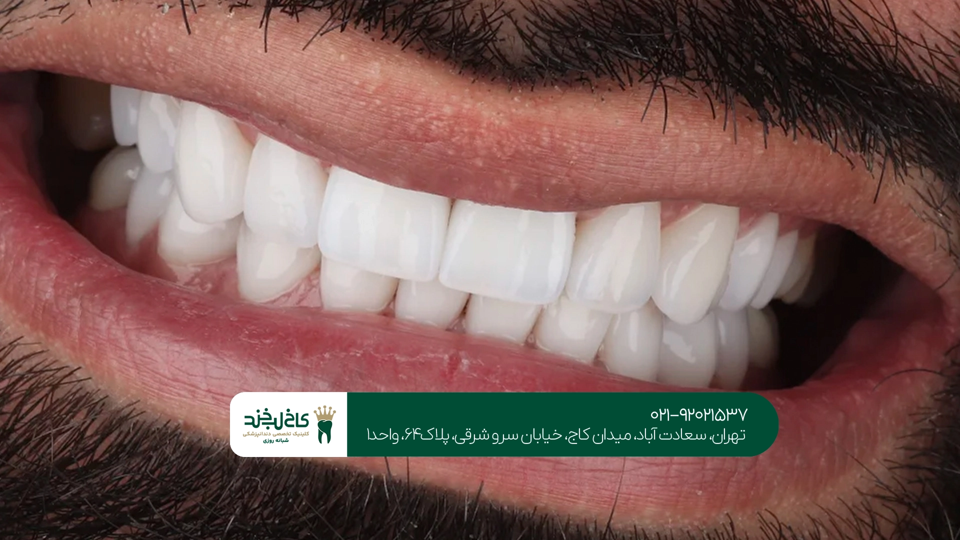 لمینت دندان در تهران