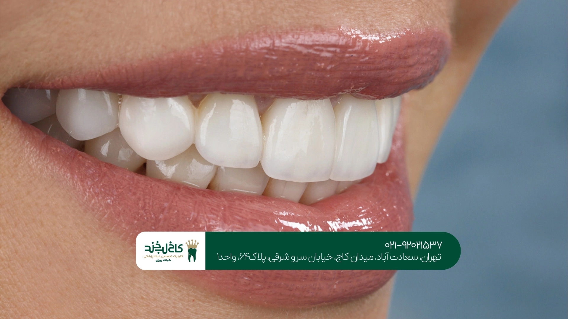 مزایا و معایب لمینت دندان برای دندانهای نامرتب