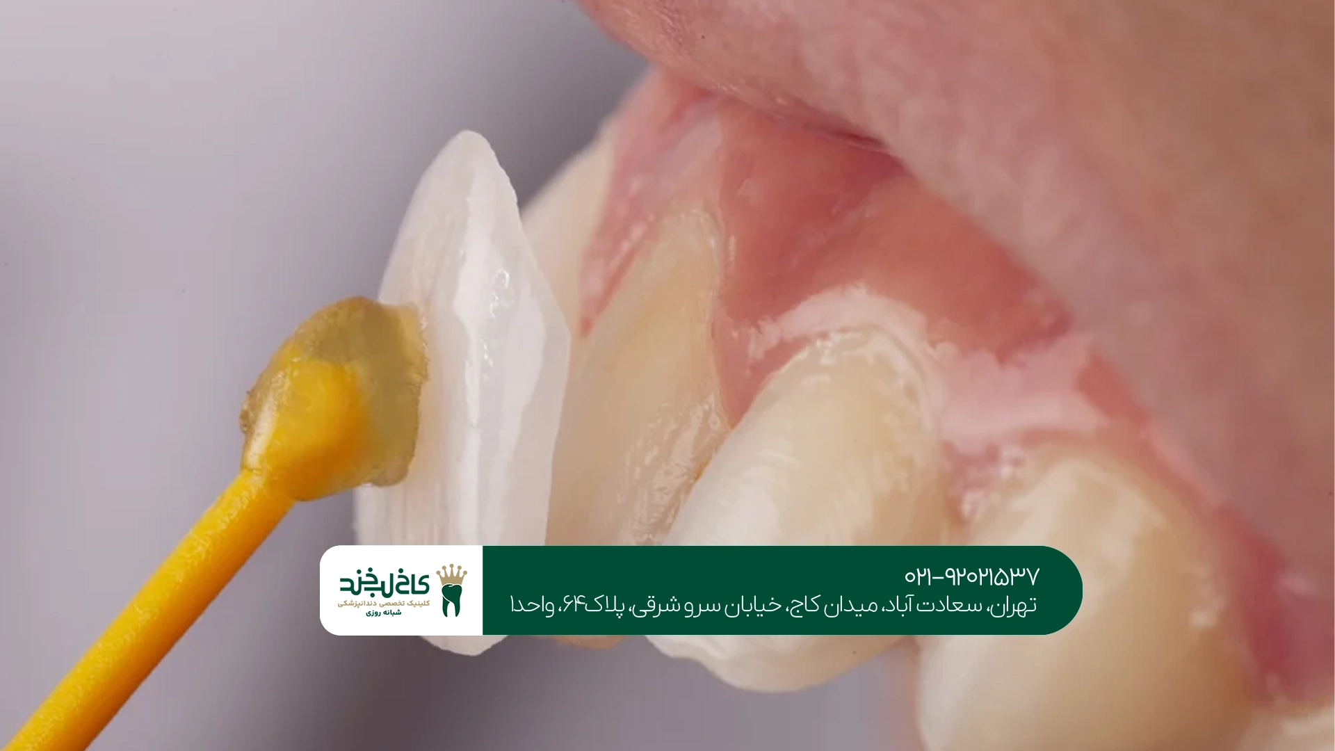 آیا لمینت دندان برای همه افراد مناسب است؟