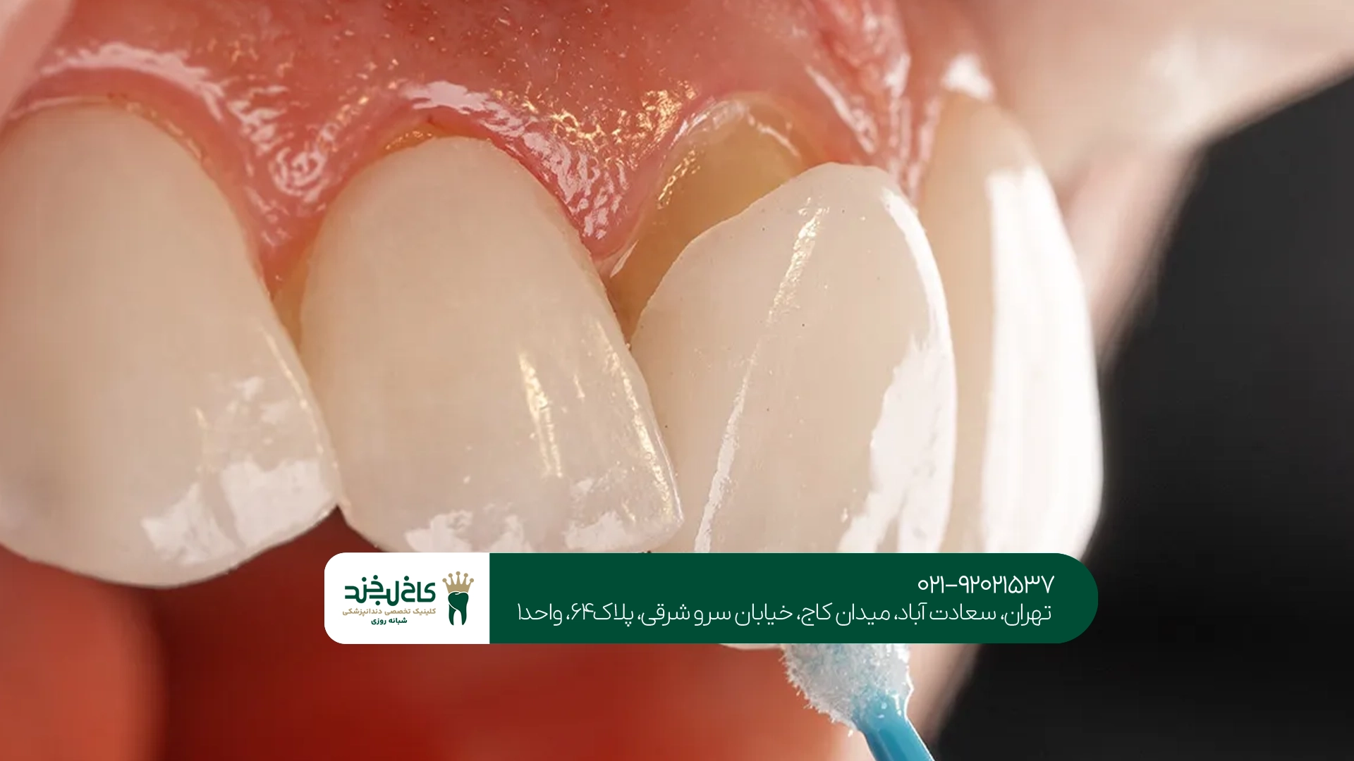 لمینت دندان در تهران