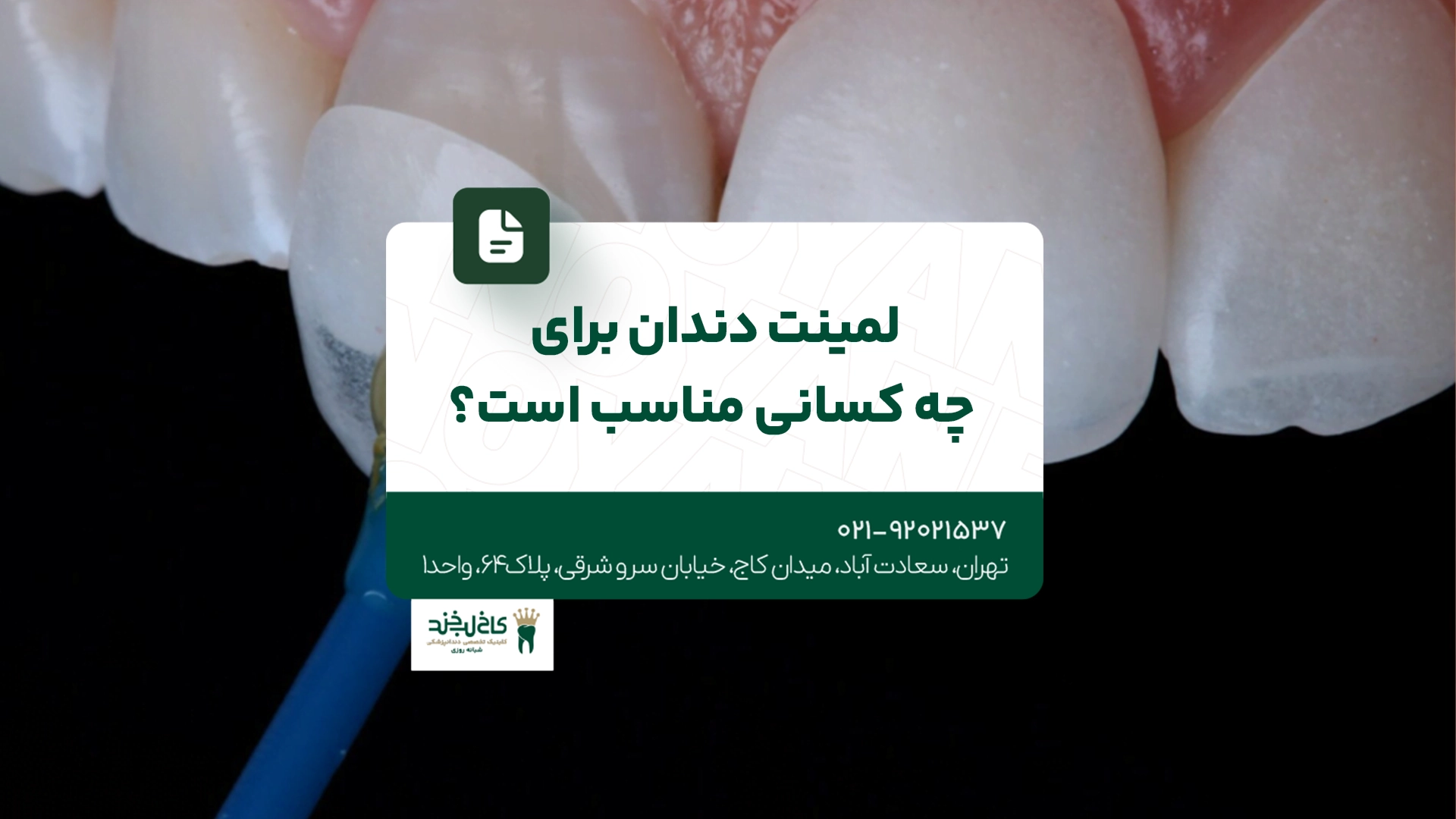 لمینت دندان برای چه کسانی مناسب است