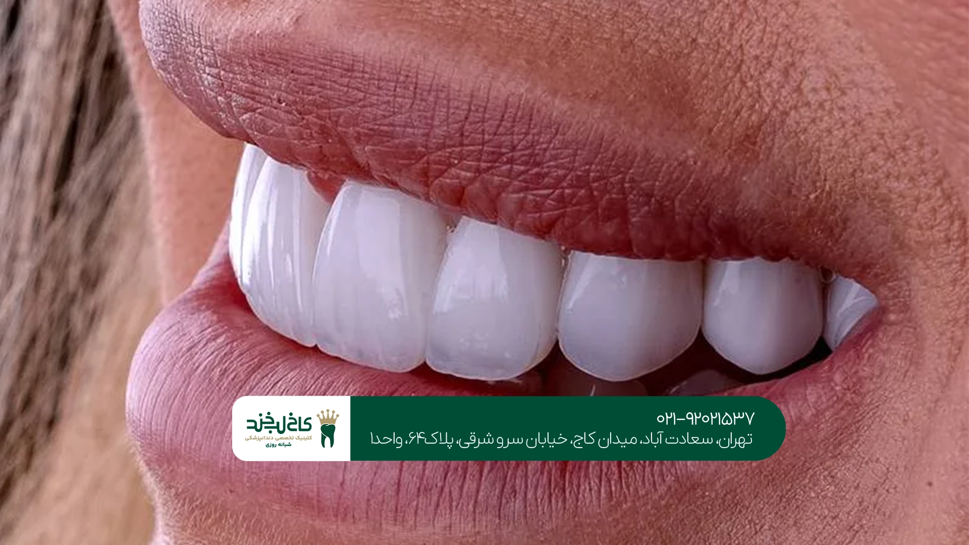 لمینت دندان در کاخ لبخند لمینت دندان در کاخ لبخند