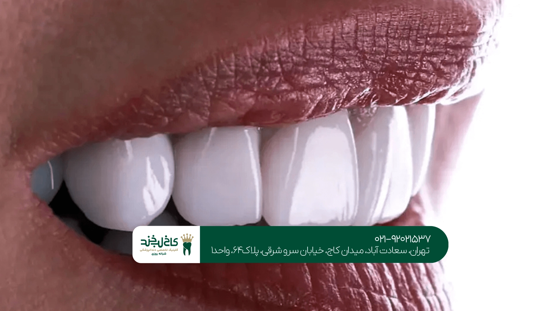 مزایای لمینت دندان مزایای لمینت دندان