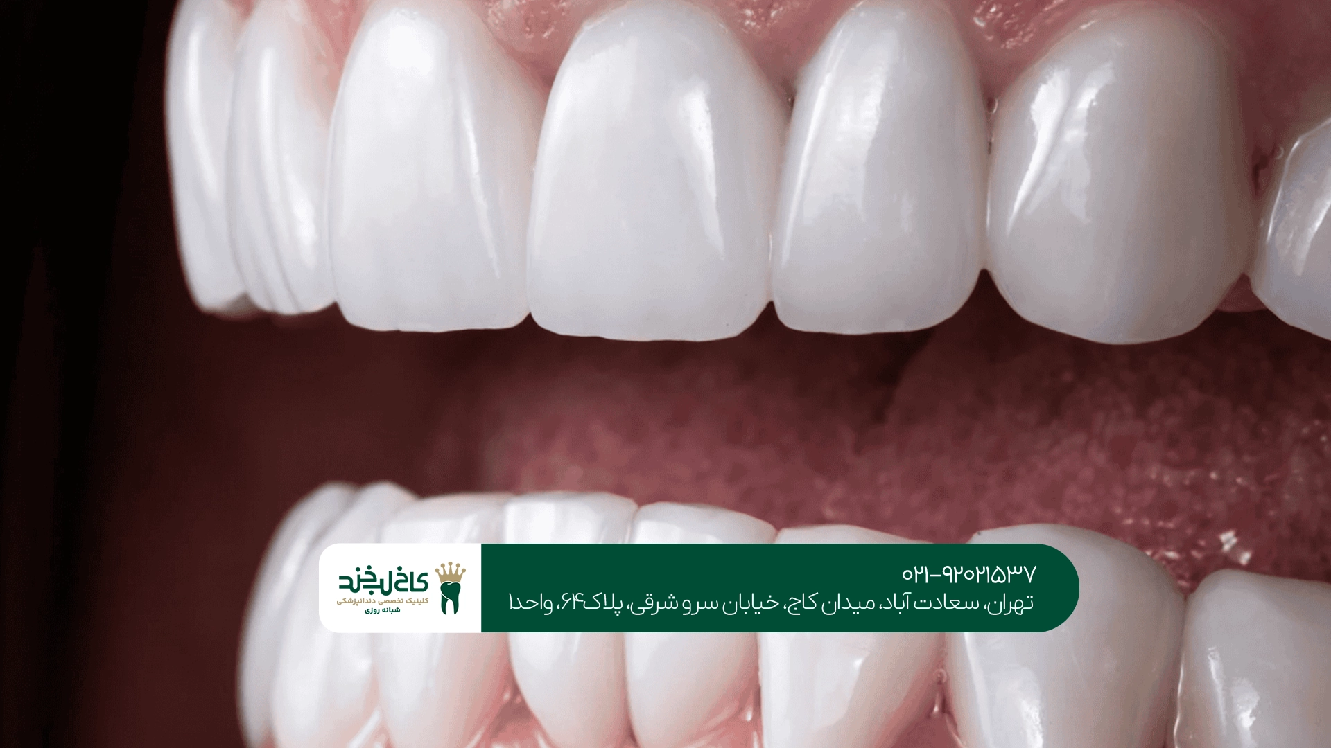لمینت دندان چیست؟ لمینت دندان چیست؟