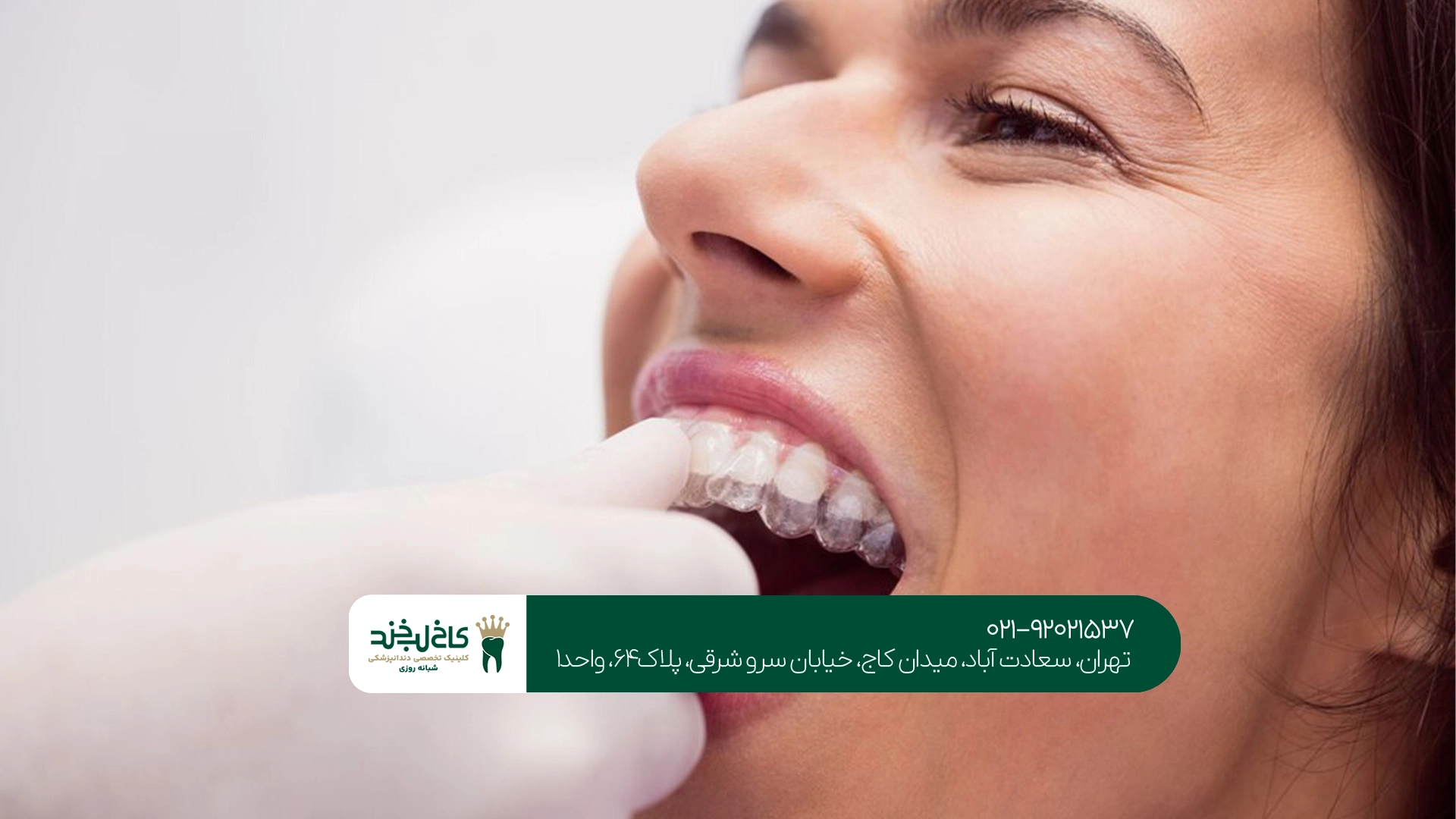 مراقبتهای بعد از لمینت دندان