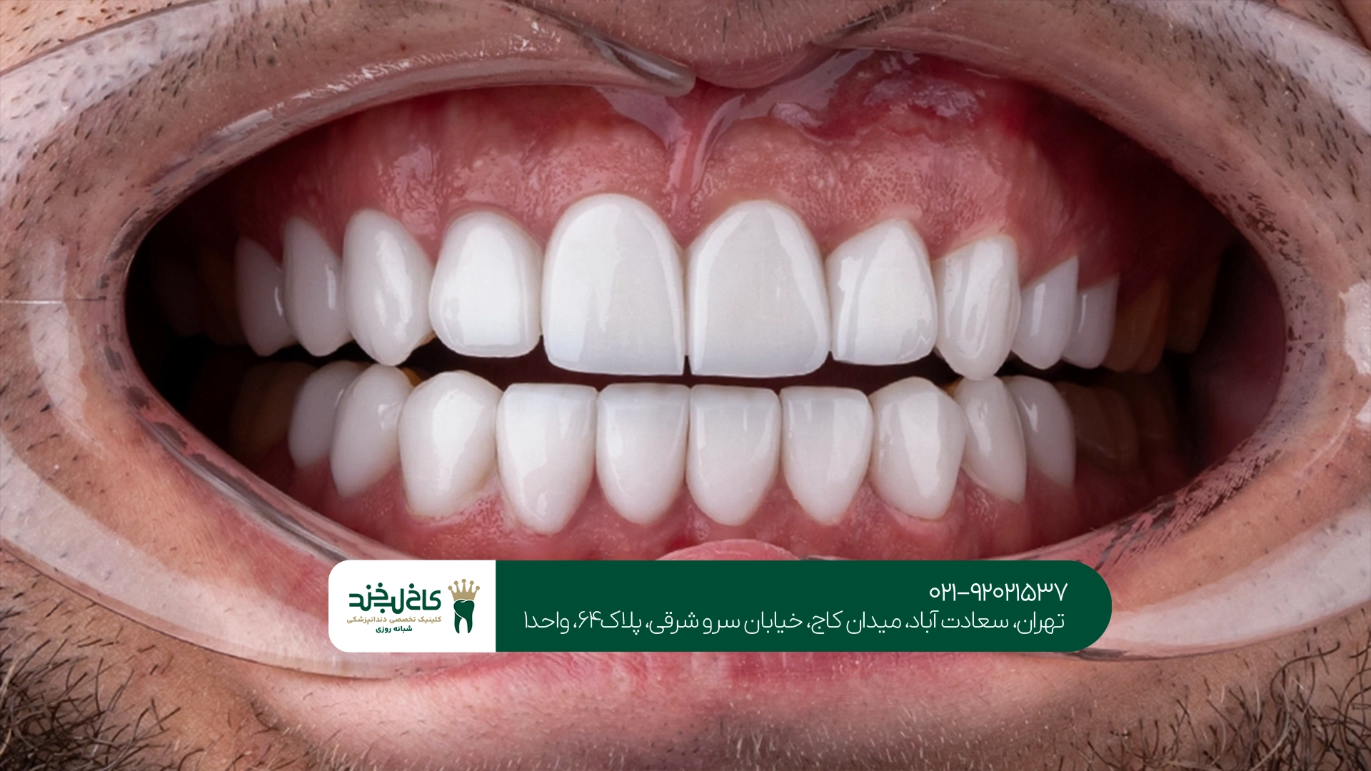 تفاوت لمینت و کامپوزیت ونیر تفاوت لمینت و کامپوزیت ونیر
