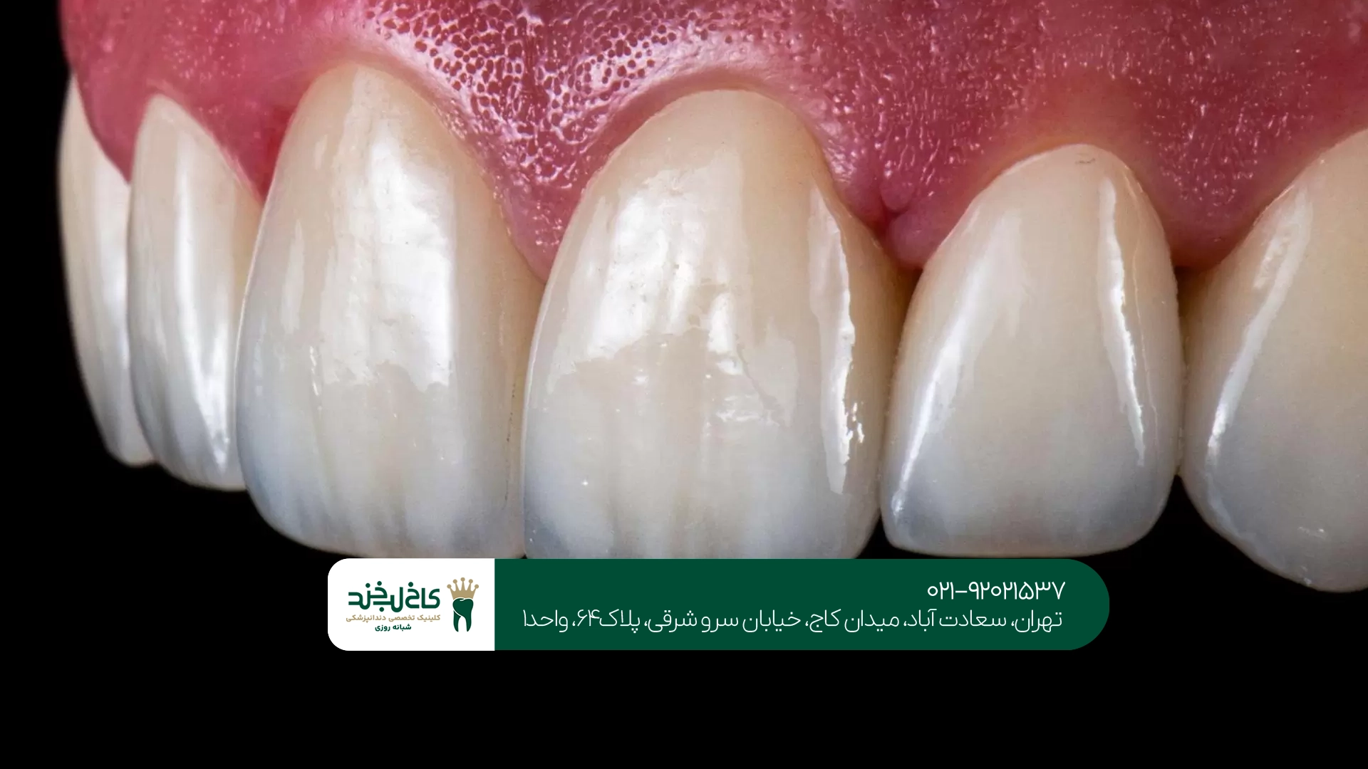 بهترین دکتر لمینت سرامیکی در تهران بهترین دکتر لمینت سرامیکی در تهران